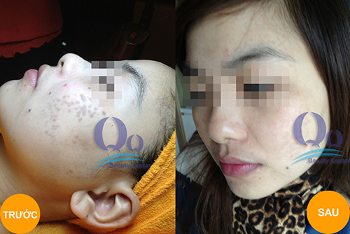 cách trị tàn nhang bằng công nghệ laser