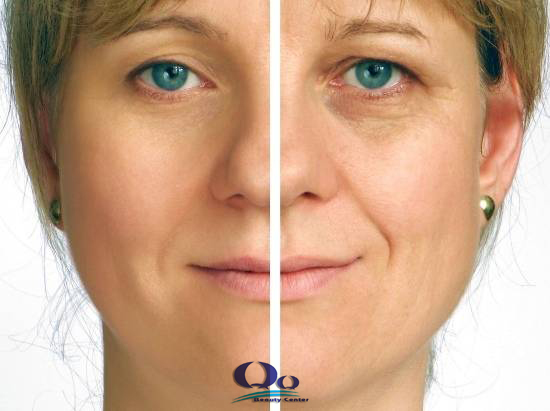 Điều trị xóa  bọng mắt