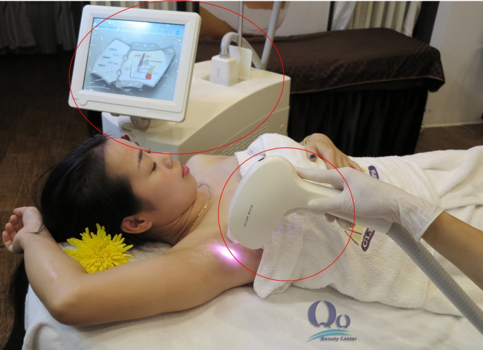 Phương pháp triệt lông nách giá rẻ tại Hà Nội bằng công nghệ Diode Laser được đánh giá với nhiều ưu điểm vượt trội. 
