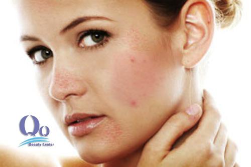 Trị mụn đúng cách vào mùa đông