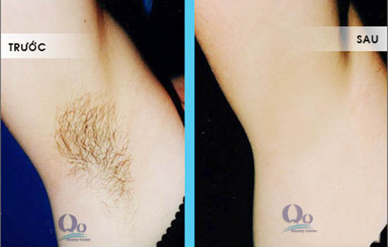 Thanh Quỳnh là địa chỉ triệt lông nách uy tín