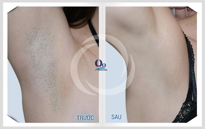 Triệt lông nách an toàn