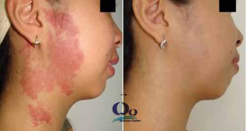 Xóa bớt bẩm sinh nhanh chóng