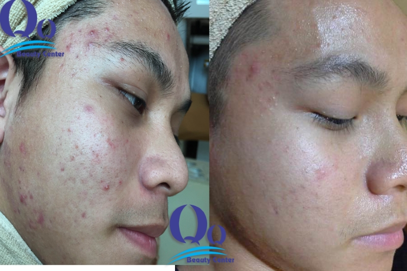 hinh anh dieu tri mun boc