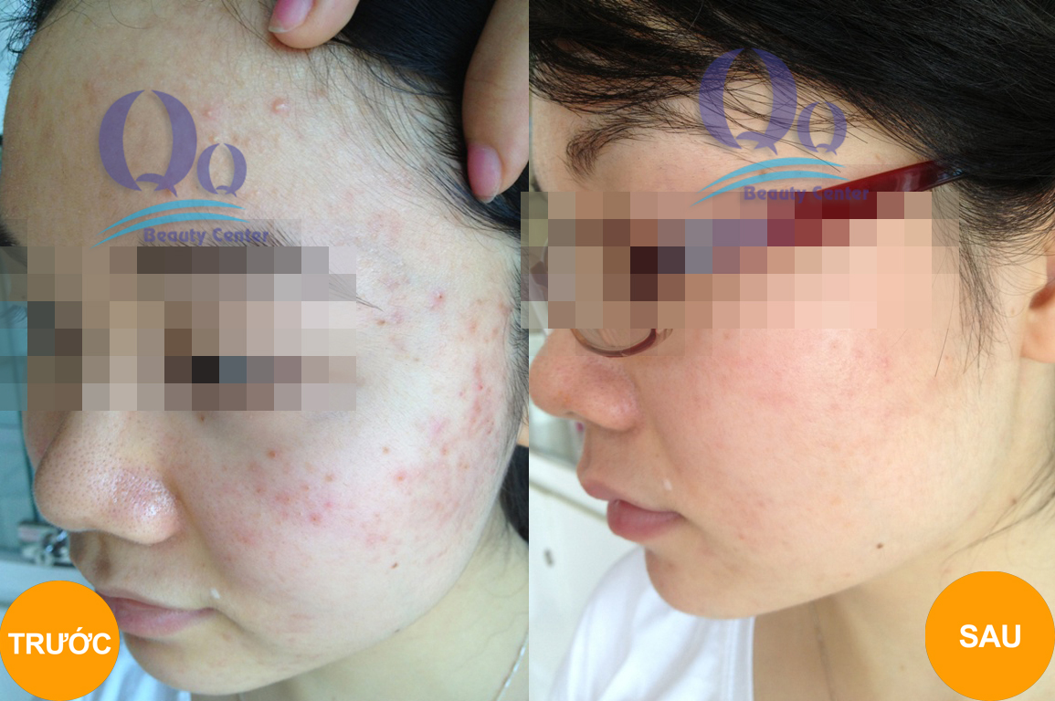 Điều trị viêm da dị ứng