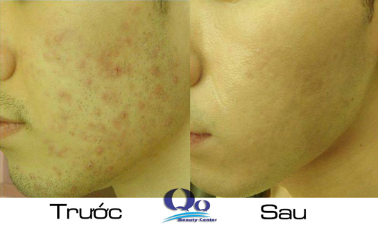 Cach tri mun trung ca cho nam gioi hieu qua hinh anh 3