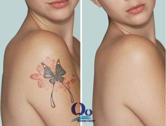 Cách xóa hình xăm nghệ thuật trên người