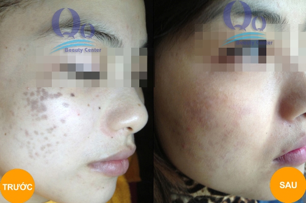 Cach xoa tan nhang tren mat nhanh chong hinh anh 2