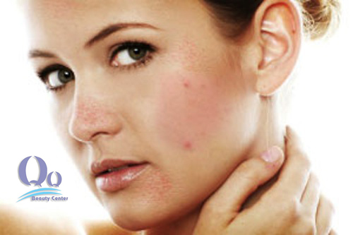 Chăm sóc da mụn đúng bài bản