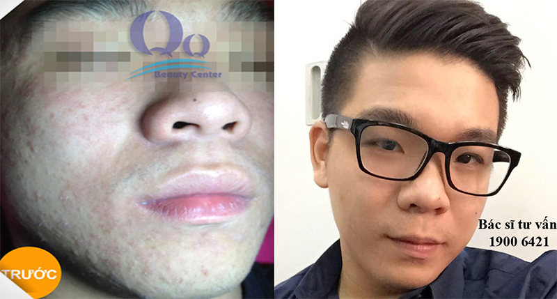 hinh anh truoc va sau khi dieu tri mun