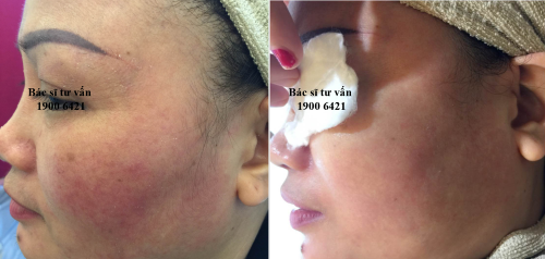 Cách chữa dị ứng mỹ phẩm