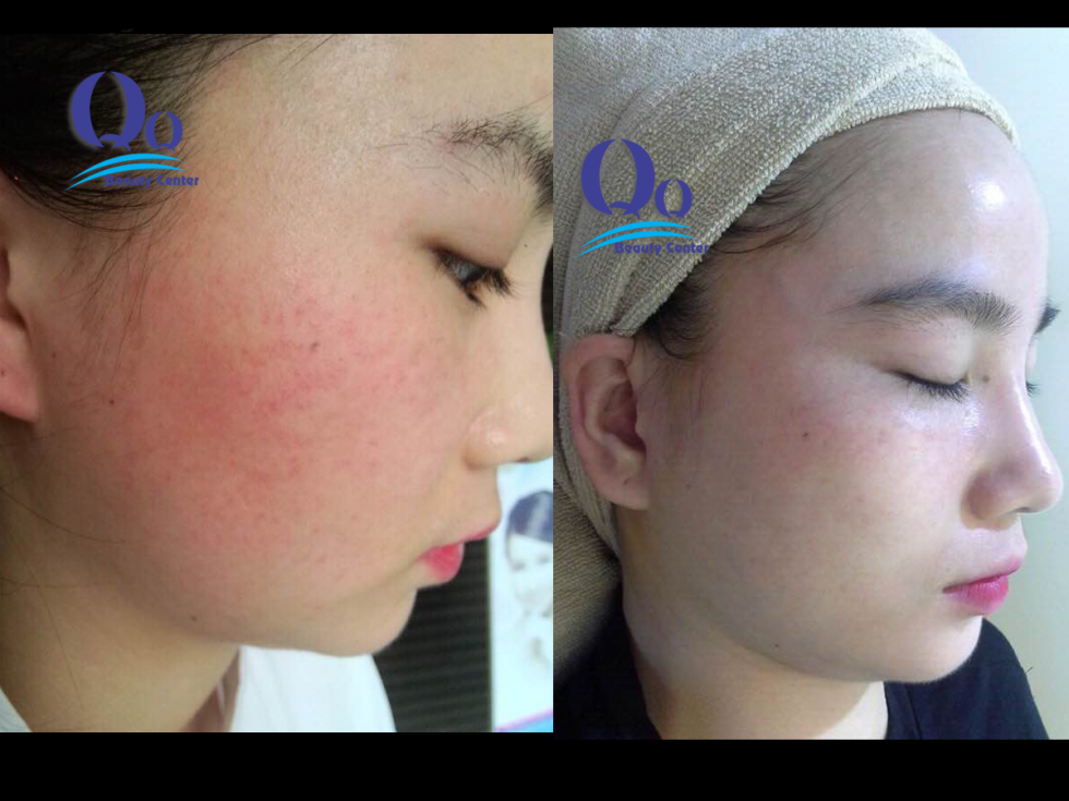 dieu tri viem da di ung