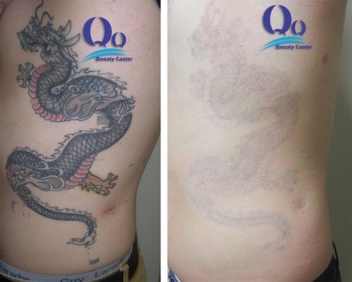 xoa hinh xam o dau tot ha noi