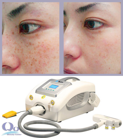 Bi quyet tri tan nhang nhanh chong hinh anh 2 