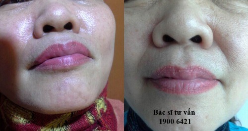 Mụn màu trắng ở trên môi