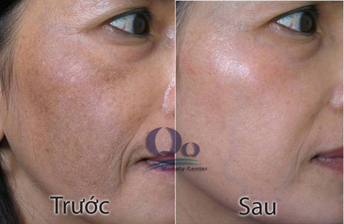 Dieu tri doi moi bang cong nghe cao hinh anh 2