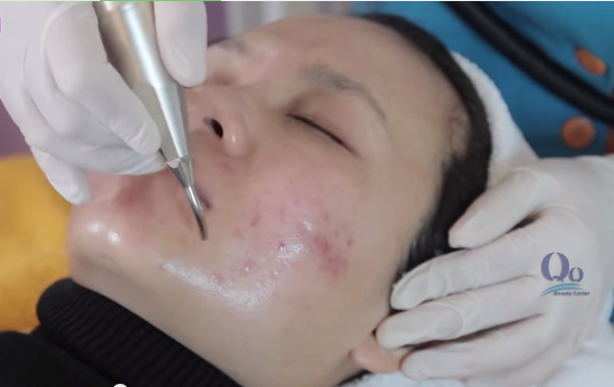 Dieu trị mun cam hieu qua nhat hinh anh 2