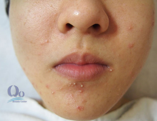 Dieu trị mun cam hieu qua nhat hinh anh 