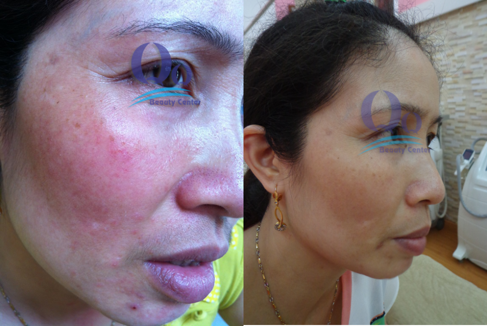 Dieu tri viem da di ung hinh anh