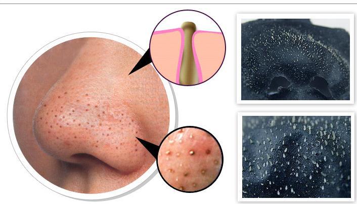 Địa chỉ trị mụn đầu đen tận gốc