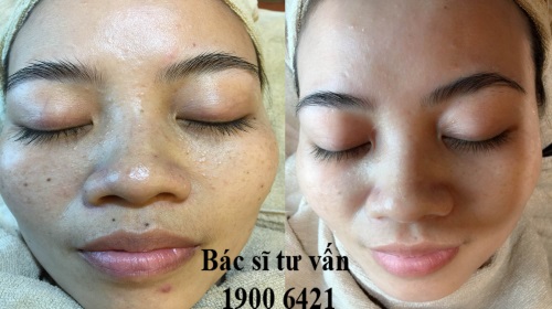 chua tri viem lo chan long o benh vien da lieu