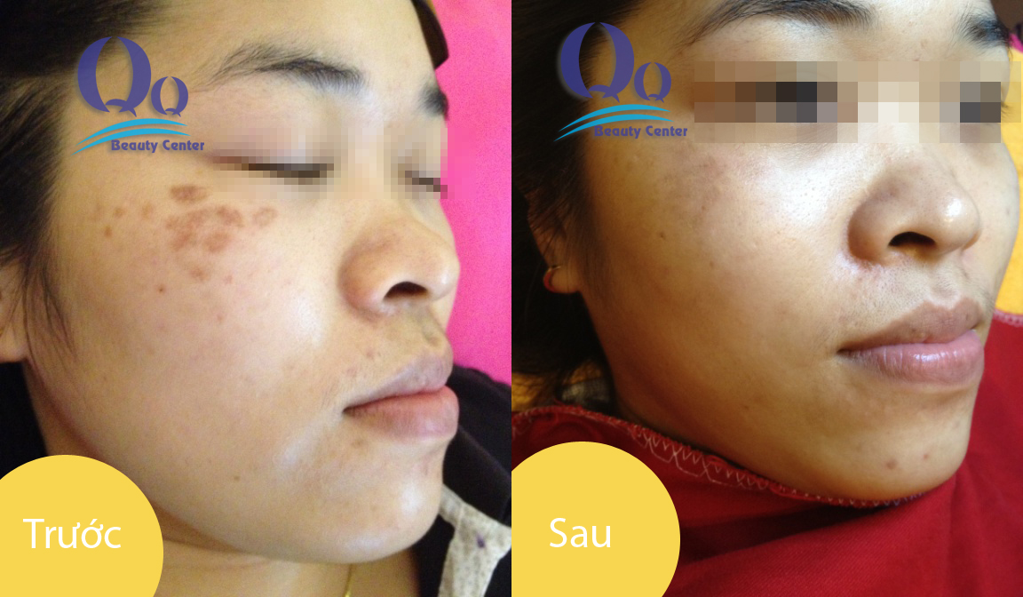 Điều trị nám đốm hiệu quả