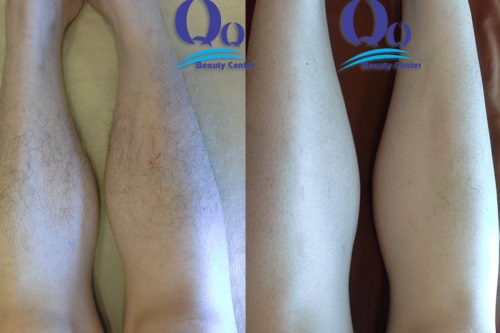 chua tri viem lo chan long o benh vien da lieu