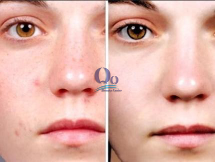 Phương pháp chữa da mặt sần sùi và ngứa