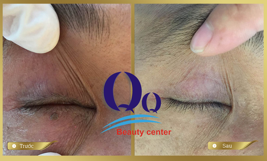 Có nên tẩy nốt ruồi ở mép?