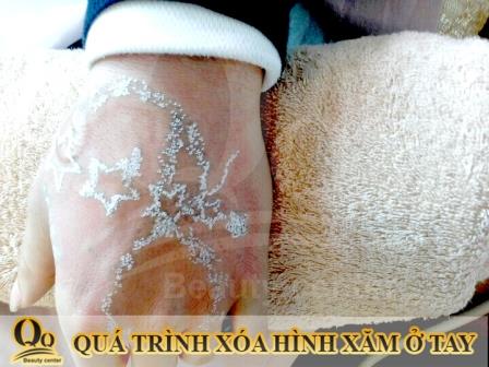 Xóa xăm có hết được không ?