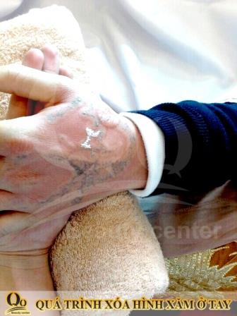 xoa xam co dau khong