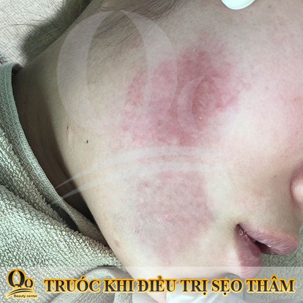 Chiếu laser trị thâm có tốt không ?