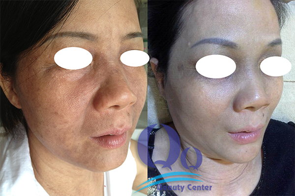 Điều trị đồi mồi ở bệnh viện 108 có tốt không ?