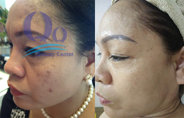 truoc khi dieu tri doi moi