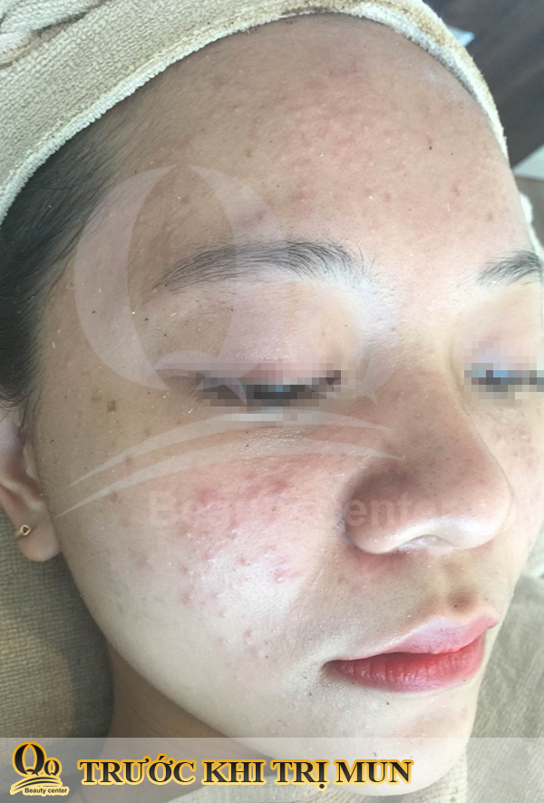 Điều  trị mụn tuổi dậy thì ở nam