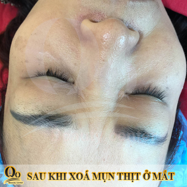 Hình ảnh sau khi điều mụn thịt hiệu qủa  ở mắt 