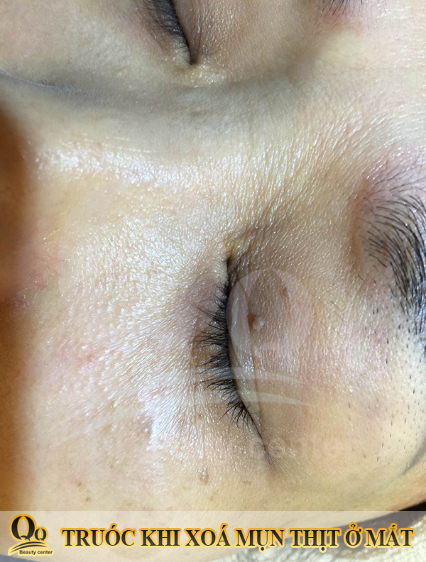 Đốt mụn thịt có để lại sẹo không ?