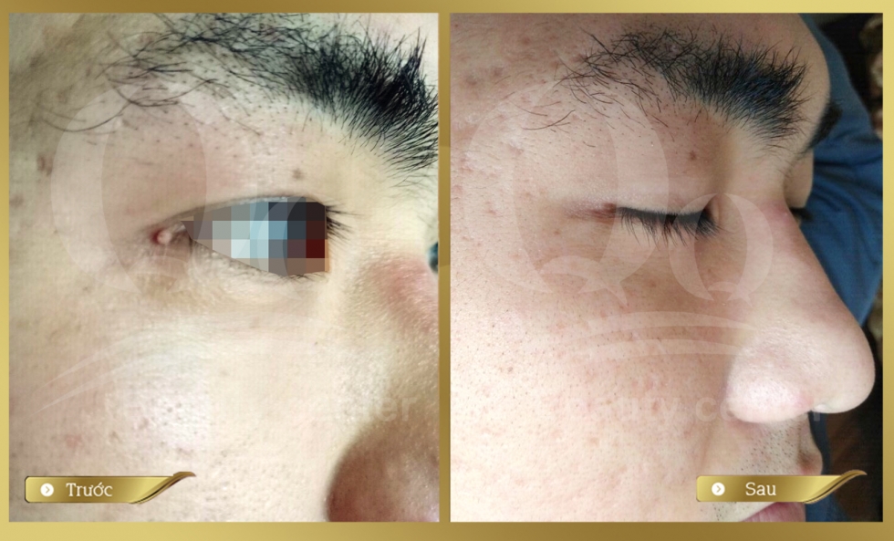 Hinh anh xoa not ruoi mun thit