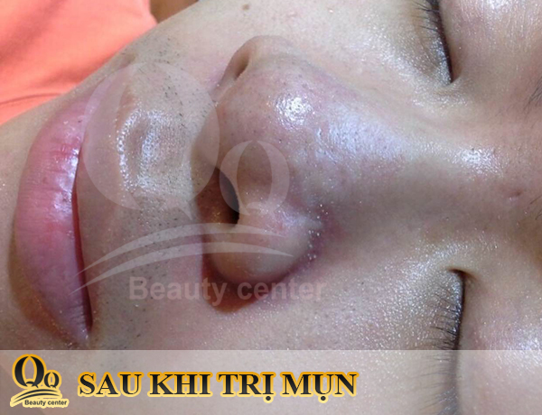 Sản phẩm trị mụn tốt nhất cho nam