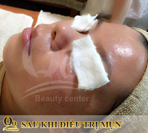 Điều trị mụn thịt ở thẩm mỹ viện Thanh Quỳnh 