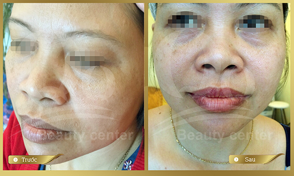 xoa mau moi phun xam