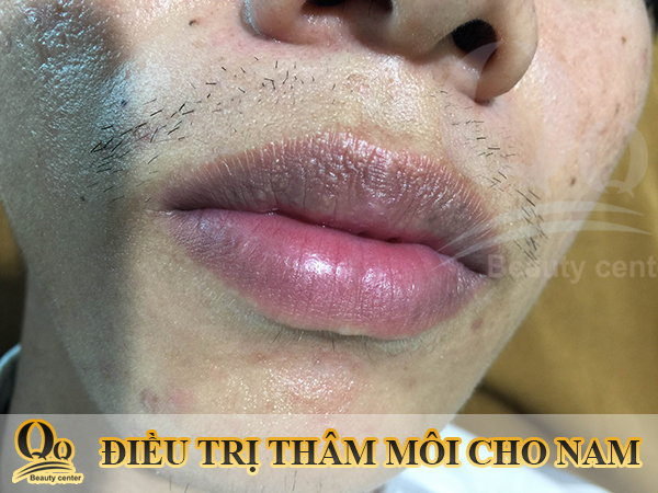 Chữa trị hạt fordyce sẩn ở  da môi 