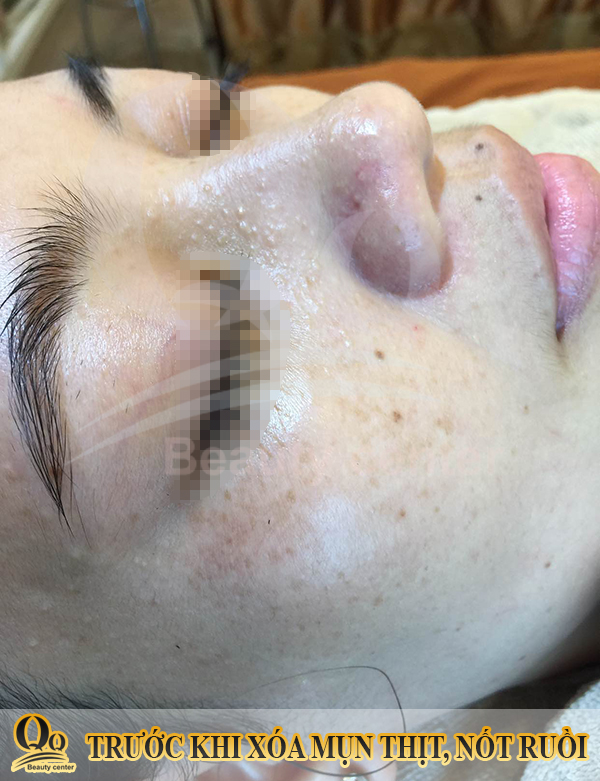 Gel tẩy nốt ruồi của nga có hiệu quả không