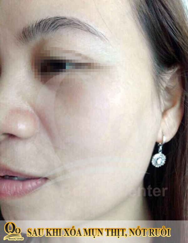 Hình ảnh sau khi điều trị mụn thịt