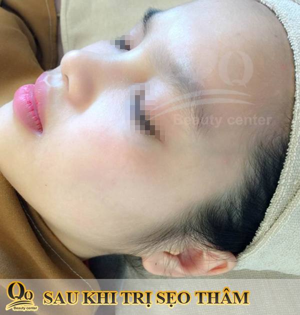 Thẩm mỹ viện chuyên trị sẹo Hà Nội