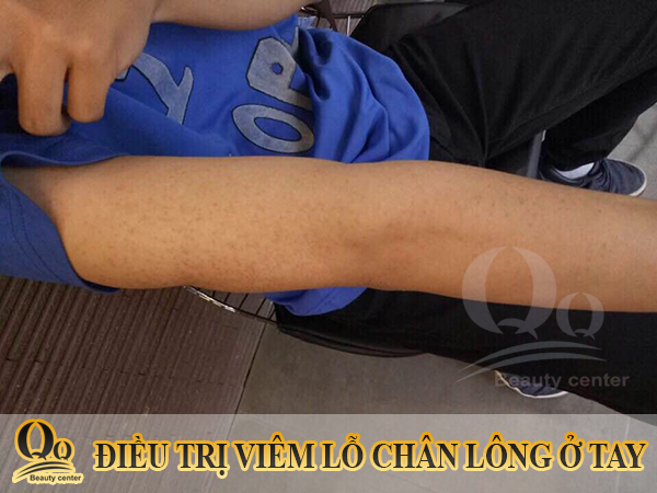 Thuốc bôi dày sừng nang lông