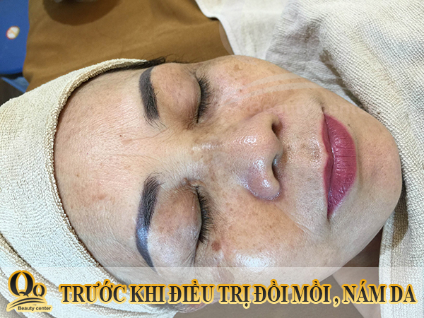 Thuốc bôi trị đồi mồi nào hiệu quả nhất ?