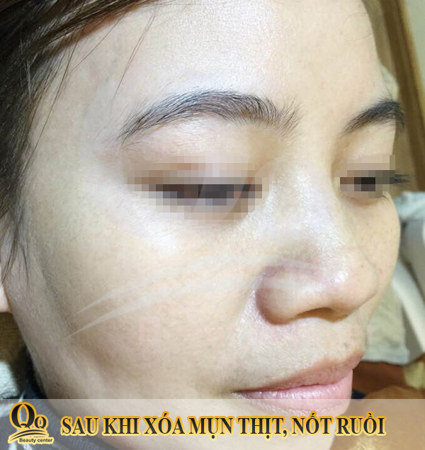 thuoc boi tri mun thit nhat co tot khong