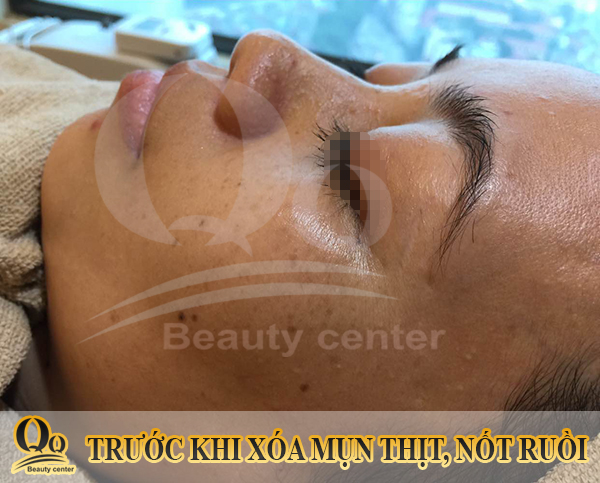 thuoc tri mun thit quanh mat