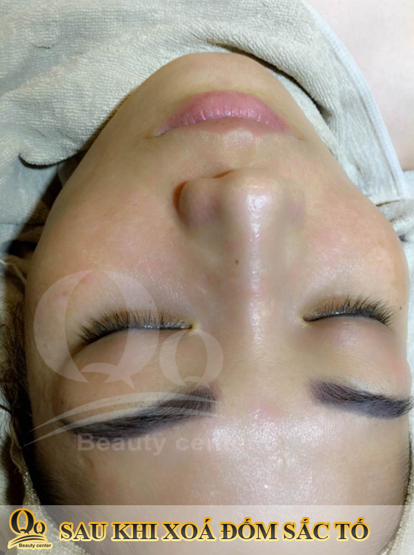 Trị nám tại bệnh viện da liễu hà nội có tốt không ?